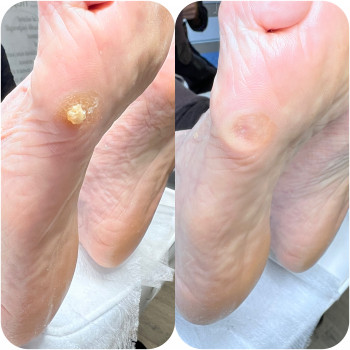 Стержневий мозоль