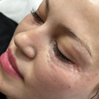 Біоревіталізація периорбітальної зони.
    