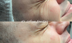 Ботулинотерапия Врач-косметолог Софія Львов