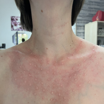 Мезотерапія декольте, допомагає покращити пружність та еластичність шкіри, зволожує.