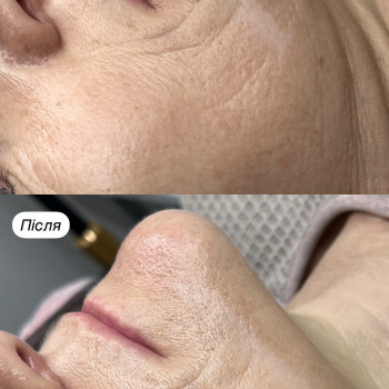 Екзосомальна ферментотерапія. Процедура направлена на ліфтинг, зволоження, освітлення та відновлення...