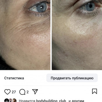 Фото из портфолио косметолога Любовь Черней (Запорожье)