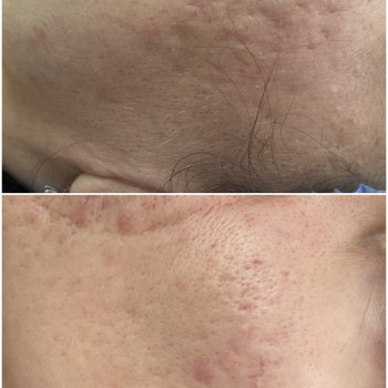 Корекція рубців