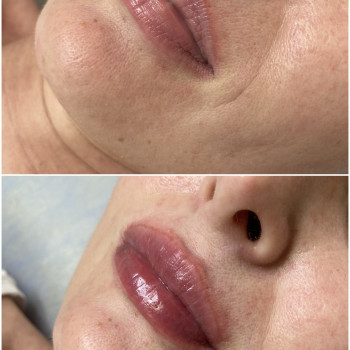 Ревіталізація і омолодження губ бустером bacio