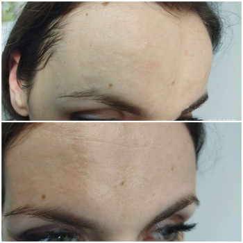 До процедури та після