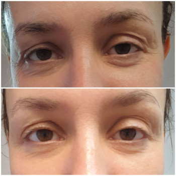 До процедури та після