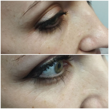 До процедури та після