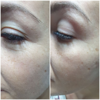 До процедури та після