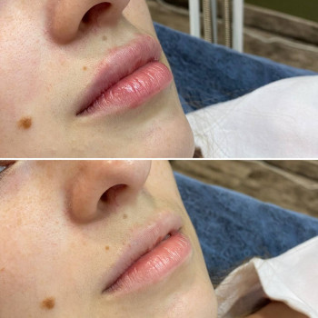 Контурна пластика губ
                    Преподаватель курсов красоты Денис Винница