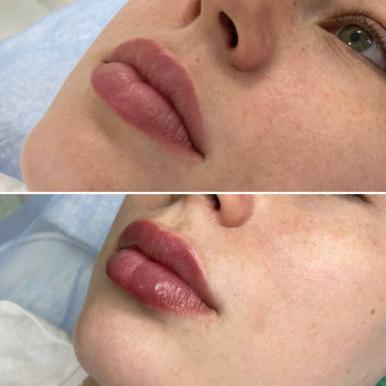 Контурна пластика губ
                    Преподаватель курсов красоты Денис Винница