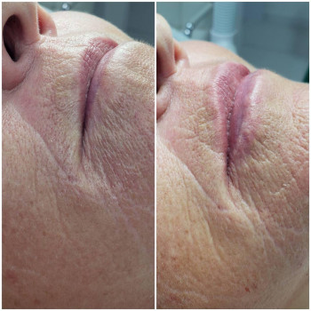 Контурна пластика губ
                    Преподаватель курсов красоты Денис Винница