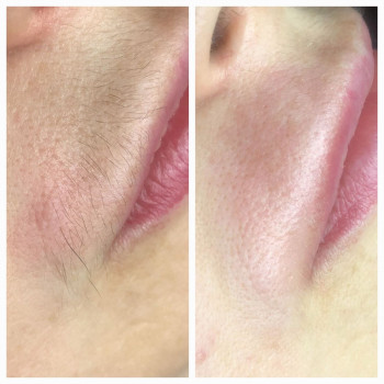 Електроепіляція
Зона:верхня губа