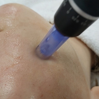 Без'інєкційна мезотерапія (мікронідлінг) 800 грн/30 хв
                    Косметолог Юлія Київ