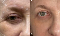 Ботулинотерапия Косметолог-инъекционист Катерина Киев