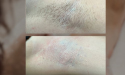 Электроэпиляция Салон красоты Мастерская Красоты "Юлии Юдиной" Киев