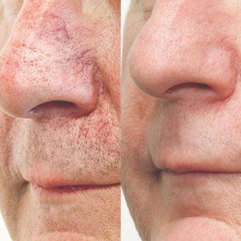 Видплення судинних сіточок лазером