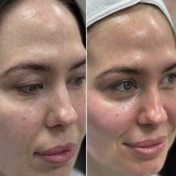 До/Після Radiesse: виражений ліфтинг-ефект і ревіталізація шкіри