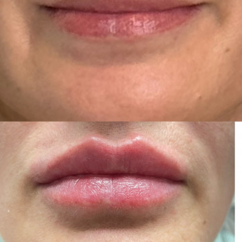 До/Після: ніжне збільшення губ — без перебільшень, з акцентом на гармонію.