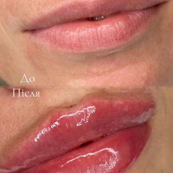 губи після процедури — натуральний обʼєм і чіткий контур вже сьогодні!