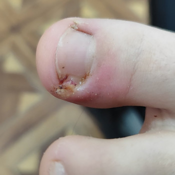 Врослий ніготь із запаленням