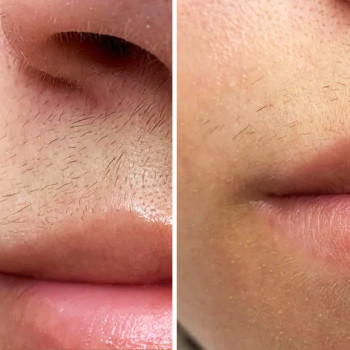 Лазерна епіляція верхньої губи (вусики)
                    Студия лазерной эпиляции Центр лазерної косметології Луцк