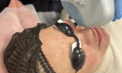 Лазерне омолодження шкіри обличчя шиї чи декольте Студія лазерної епіляції Центр лазерної косметології Луцьк