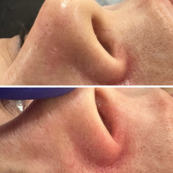 Лазерне видалення куперозу
                    Студия лазерной эпиляции Центр лазерної косметології Луцк