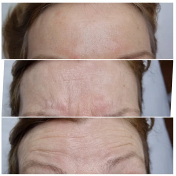 Ботулінотерапія (корекція зморшок)
                    Косметолог-ін'єкціоніст Ірина Чортків