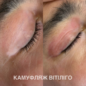 Камуфляж вітіліго одразу після процедури