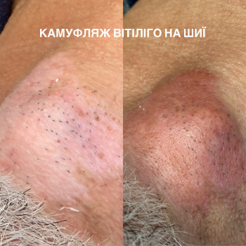 Камуфляж вітіліго на шиї. Одразу після процедури