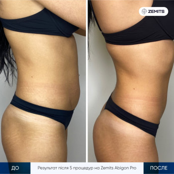 Апаратна методика корекції фігури на професійному апараті Zemits 
 