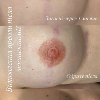 Камуфляж ареол
                    Мастер перманентного макияжа Наталя Тернополь
