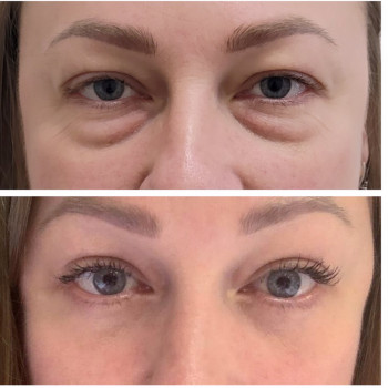 Блефаропластика
                    Пластический хирург Алла Днепр