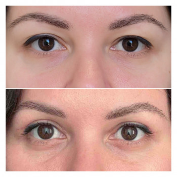 Блефаропластика
                    Пластический хирург Алла Днепр