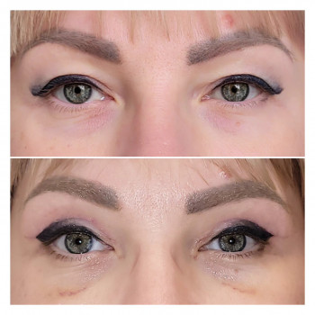 Блефаропластика
                    Пластический хирург Алла Днепр