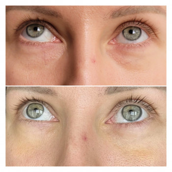 Блефаропластика
                    Пластический хирург Алла Днепр