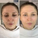 Radiesse зі знижкою, яку не можна пропустити! Косметологічний центр Сфера Плюс Київ
