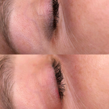 Видалення стрілки з розтушовкою лазером. 1 сеанс
      