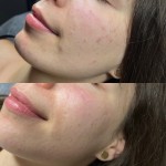 Чистка обличчя з пілінгом+киснева мезотерапія Лікар-косметолог Софія Львів