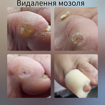 Безболісне видалення стержньового мозоля