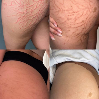 процес загоєння