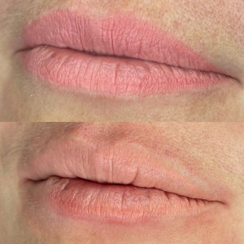 Видалення татуажу лазером
                    Майстер перманентного макіяжу Татьяна Одеса