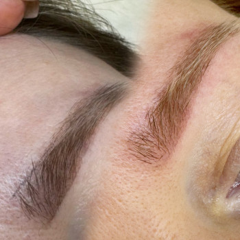 До и после удаления , линий над бровью почти не видно