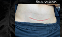 Мікронідлінг шрамів і розтяжок Мастер перманентного макияжа Наталя Тернополь