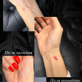 Мікронідлінг шрамів і розтяжок
                    Майстер перманентного макіяжу Наталя Тернопіль