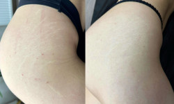 Мікронідлінг Масажист  Одеса