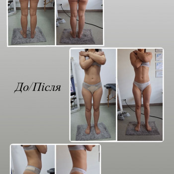 LPG Body Aesthetics, Бровари Фото - 3