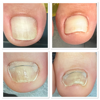   нитка при вростанні нігтя #