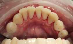 Чистка зубов Стоматолог  Киев