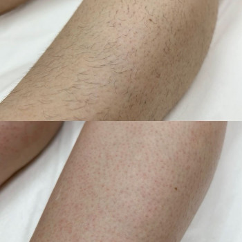 Депіляція ноги повністю
                    Мастер депиляции Світлана Черкассы